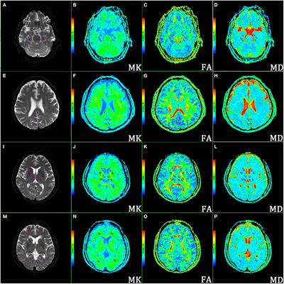 Frontiers | Microstructural and Cerebral Blood Flow Abnormalities 